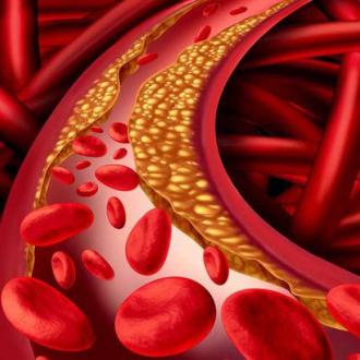 Mỡ máu cao gây tác hại gì cho sức khỏe